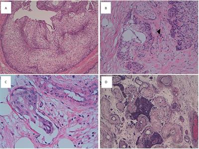 Molecular and Clinical Insights in Malignant Brenner Tumor of the Testis With Liver Metastases:A Case Report